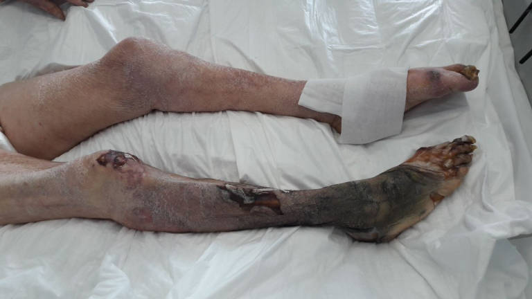 Ravenna, l'anziano con lesioni sospette trasferito dall'ospizio chiuso Ravenna, l'anziano con lesioni sospette trasferito dall'ospizio chiuso