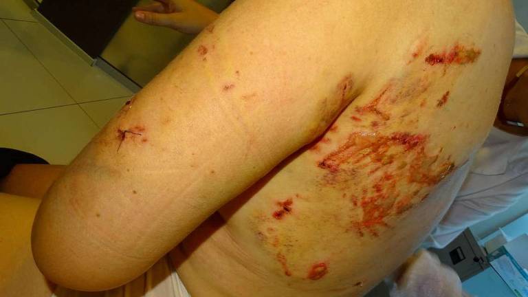 Azzannata dal cane: una festa a Gatteo per ringraziare i salvatori Azzannata dal cane: una festa a Gatteo per ringraziare i salvatori