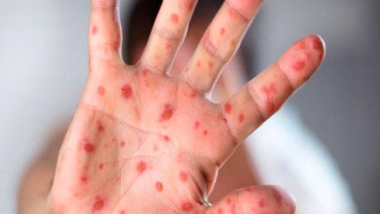 Morbillo. Allarme a Rimini, casi in aumento. Da oggi vaccinazione libera in Romagna Morbillo. Allarme a Rimini, casi in aumento. Da oggi vaccinazione libera in Romagna