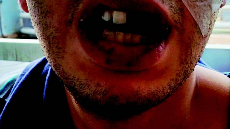 «Pestato da tre buttafuori: mio figlio rischia un occhio» «Pestato da tre buttafuori: mio figlio rischia un occhio»