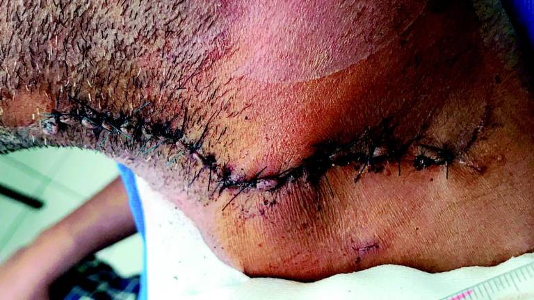 Altro che incidente, l'amico lo aveva accoltellato alla gola Altro che incidente, l'amico lo aveva accoltellato alla gola