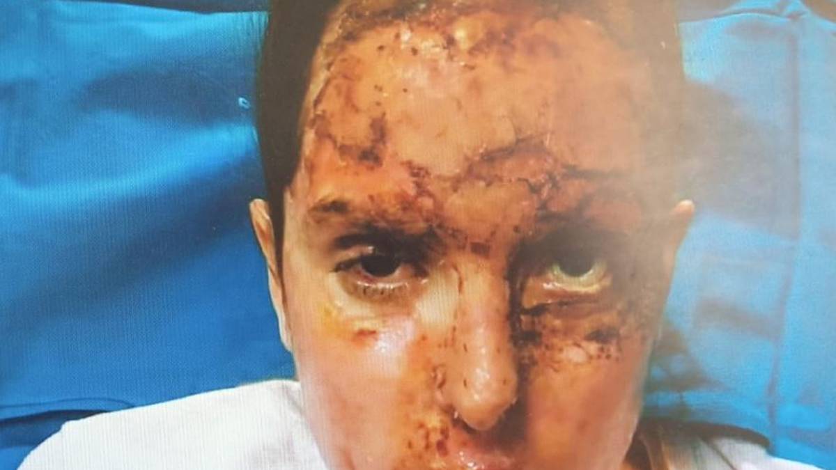 Gessica Notaro pubblica le foto dopo l'aggressione con l'acido