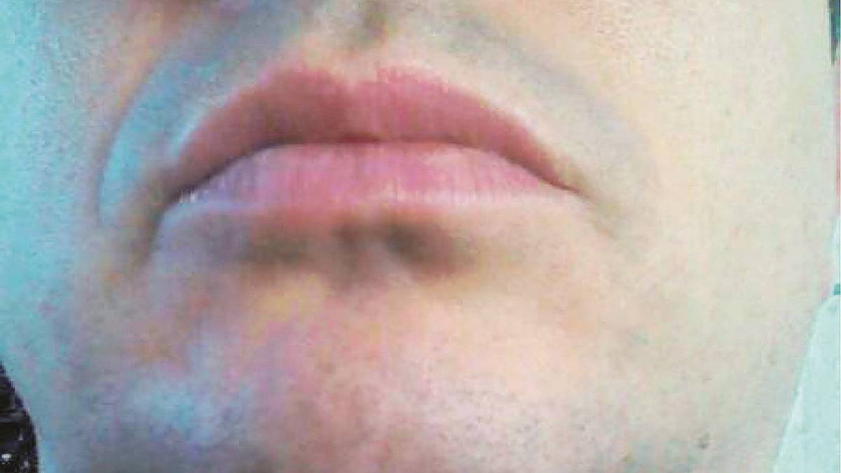 Riminese si rifà il mento: gli rimane un buco