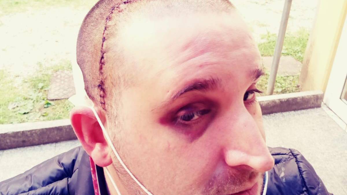 Riccione, gli sfondano il cranio per rapinarlo al bancomat