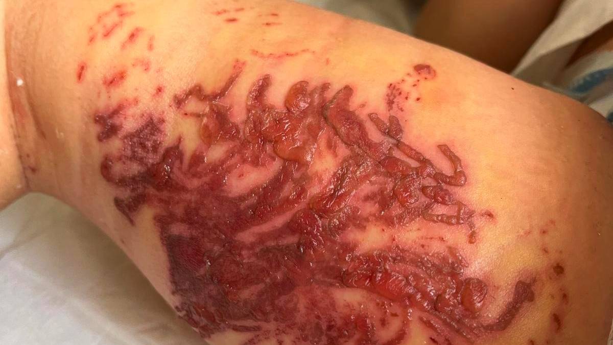 Rimini. Ustionati dagli anemoni di mare, due bimbi portati in ospedale