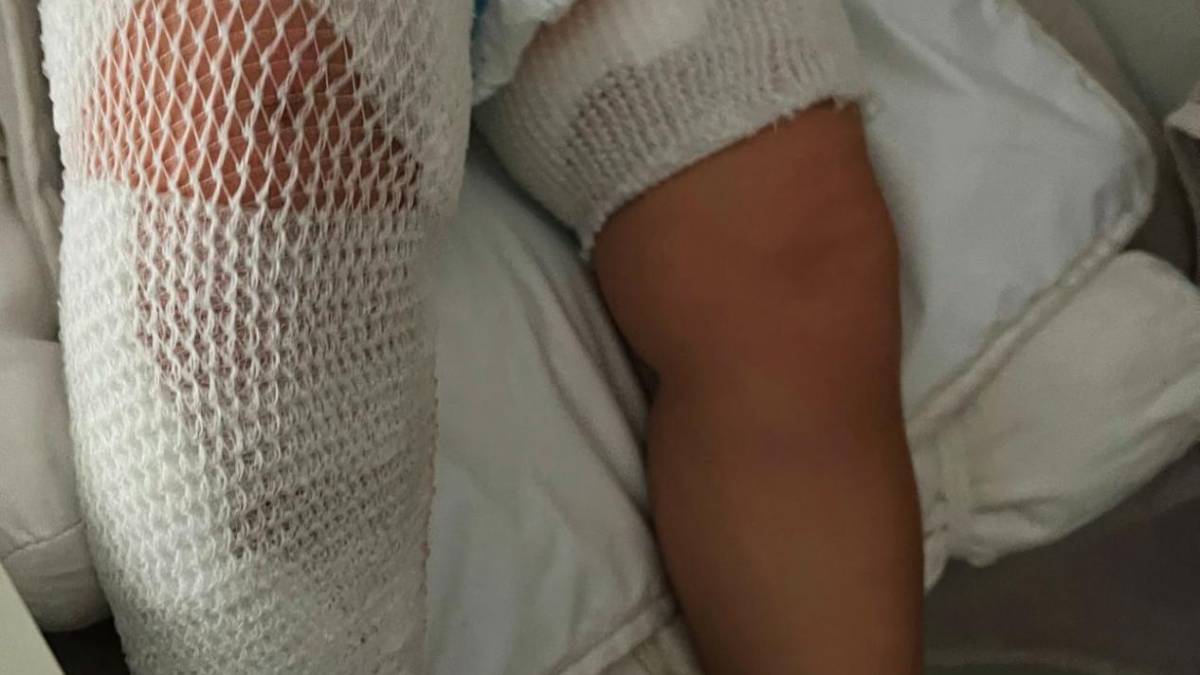 Sopra un esemplare di anemone di mare, sotto la bambina di 20 mesi medicata al Bufalini di Cesena e a destra le ferite rimaste sulla coscia