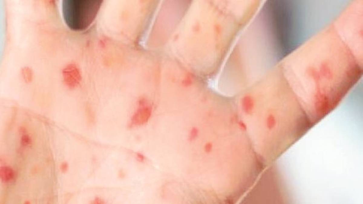 Morbillo in una scuola a Rimini. No vax, due bambini ritirati dall’asilo