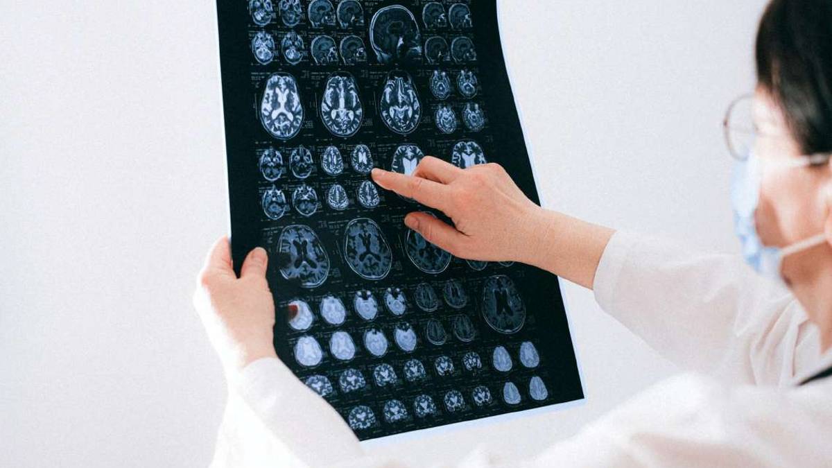 Ictus, ricoveri in calo grazie alla prevenzione