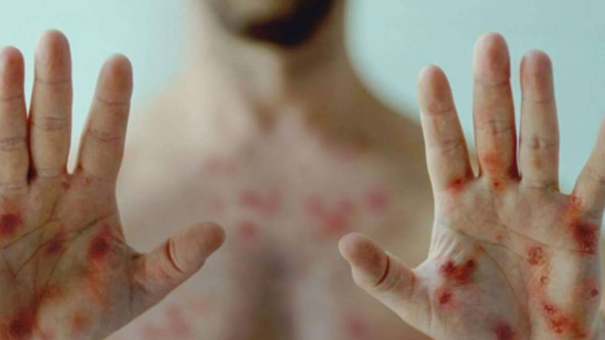 Rimini. Vaiolo delle scimmie, torna dalle Canarie e ne contagia 5