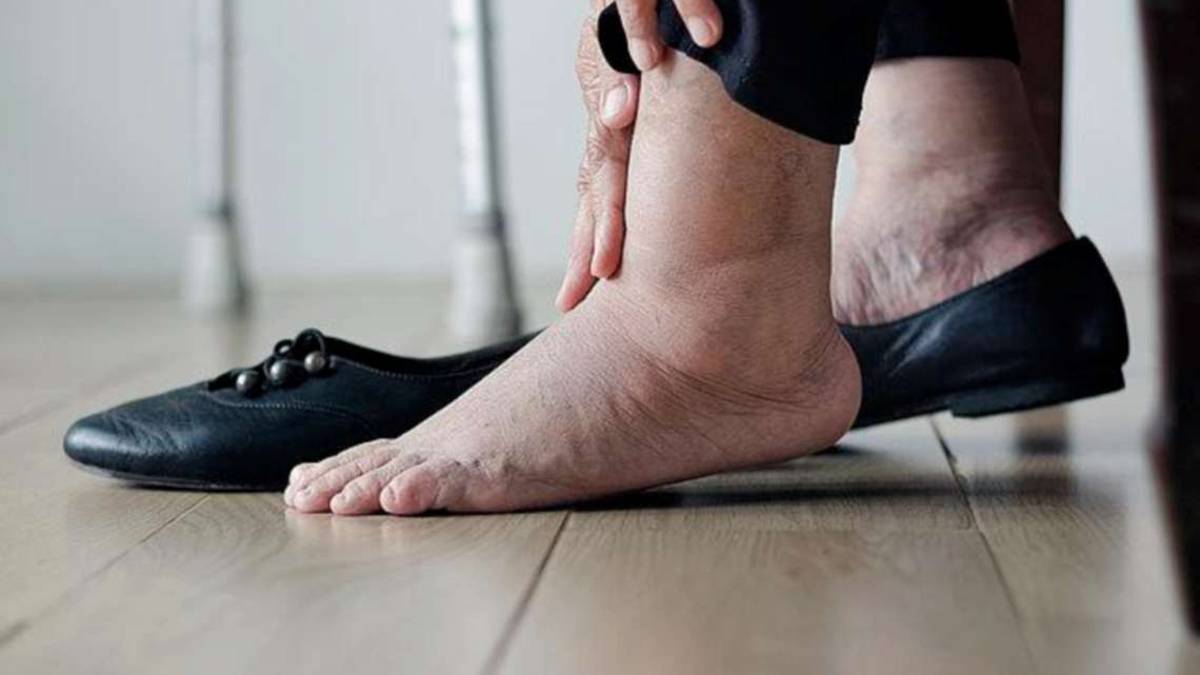 Gambe e braccia gonfie? A volte la causa è il sistema linfatico