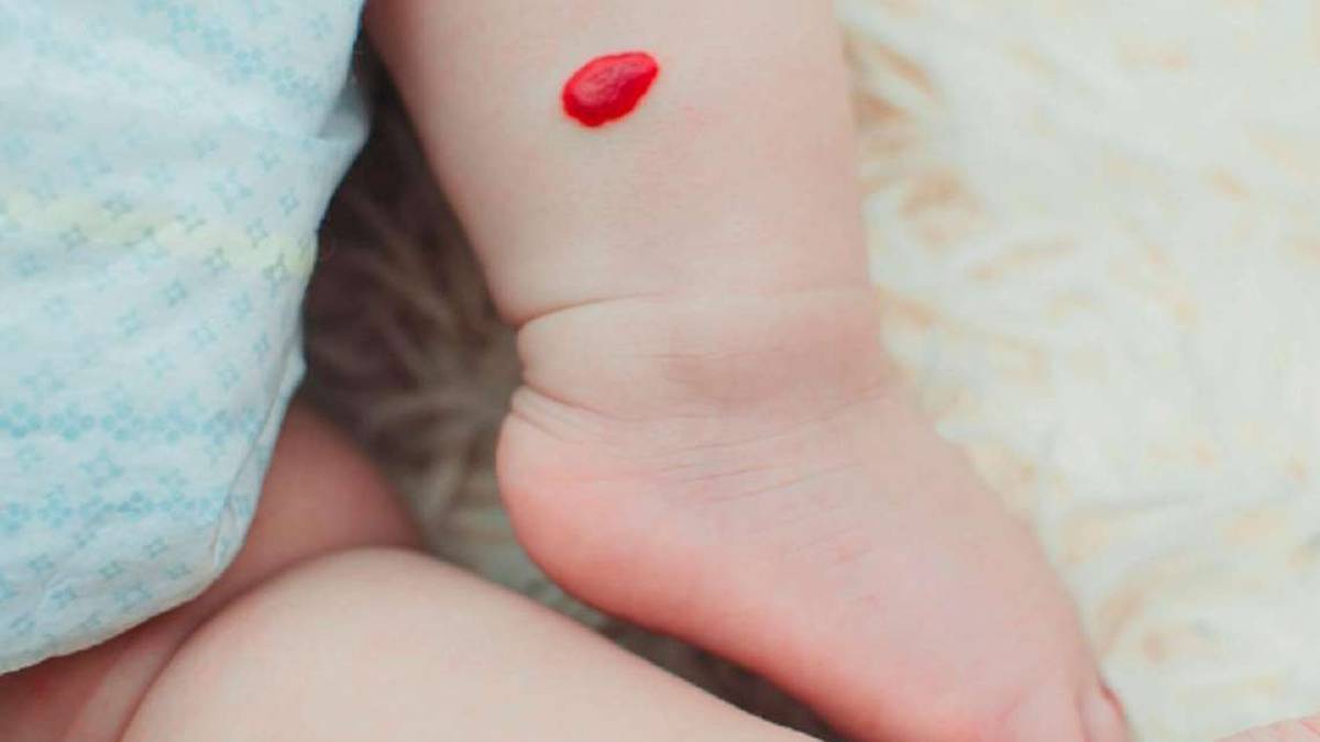 L'emangioma, un tumore benigno dei bimbi