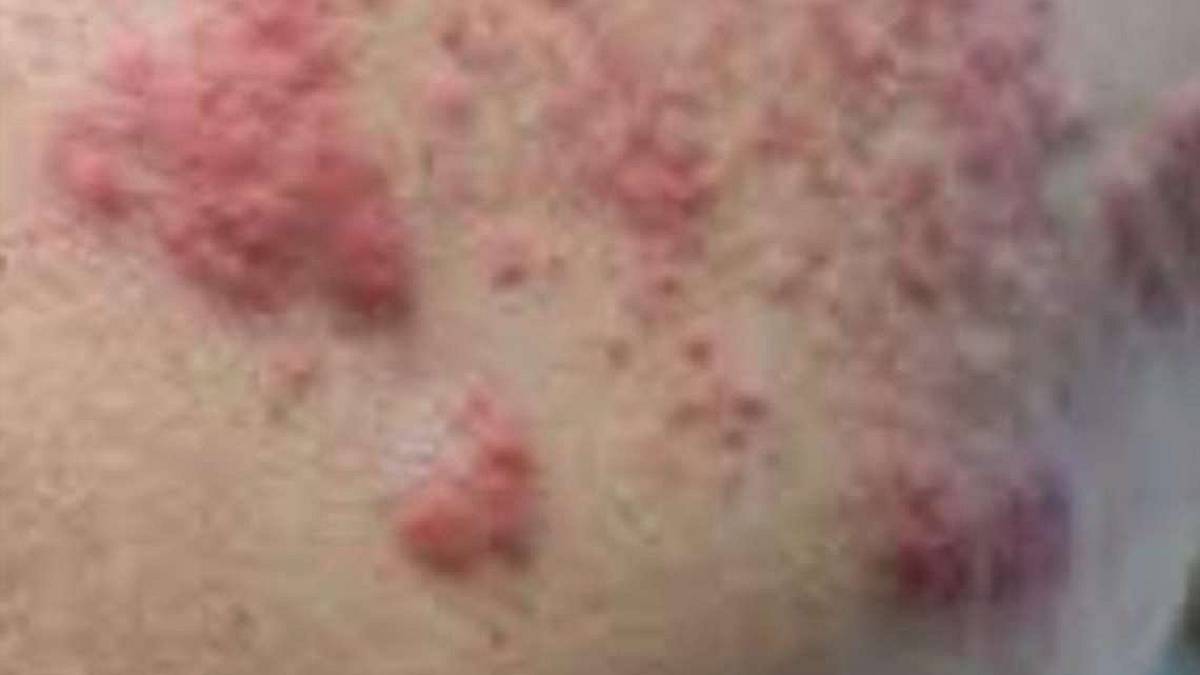 Herpes zoster, se lo incontriamo da bimbi resterà con noi