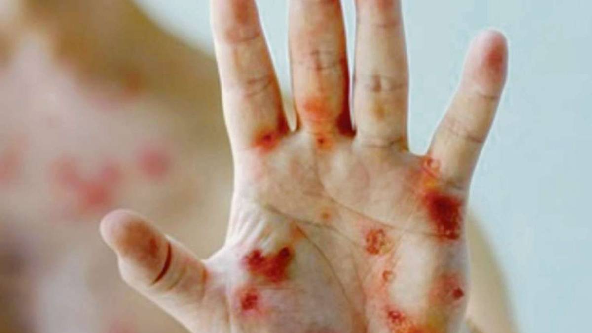 Scoperto ventenne riminese con il vaiolo delle scimmie