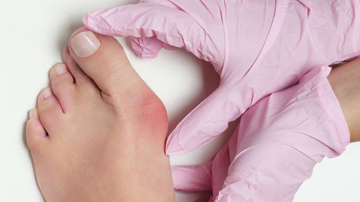 L'alluce valgo, quella brutta deformità che può provocare dolore