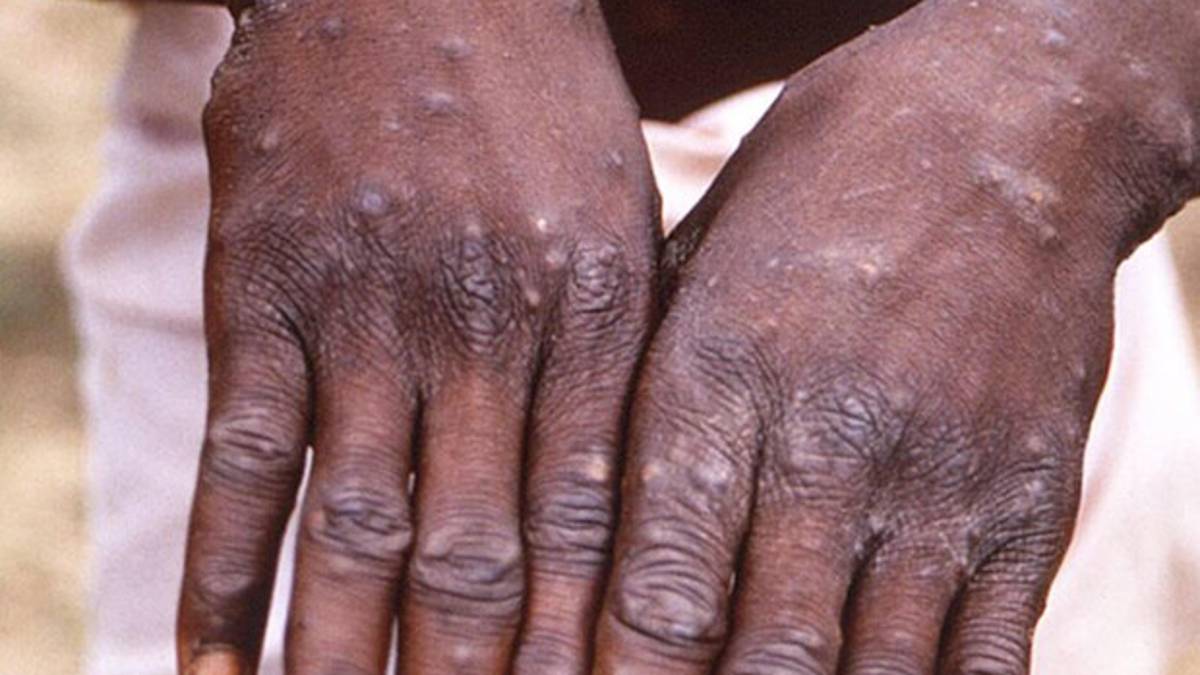 Vaiolo delle scimmie, primo caso in regione