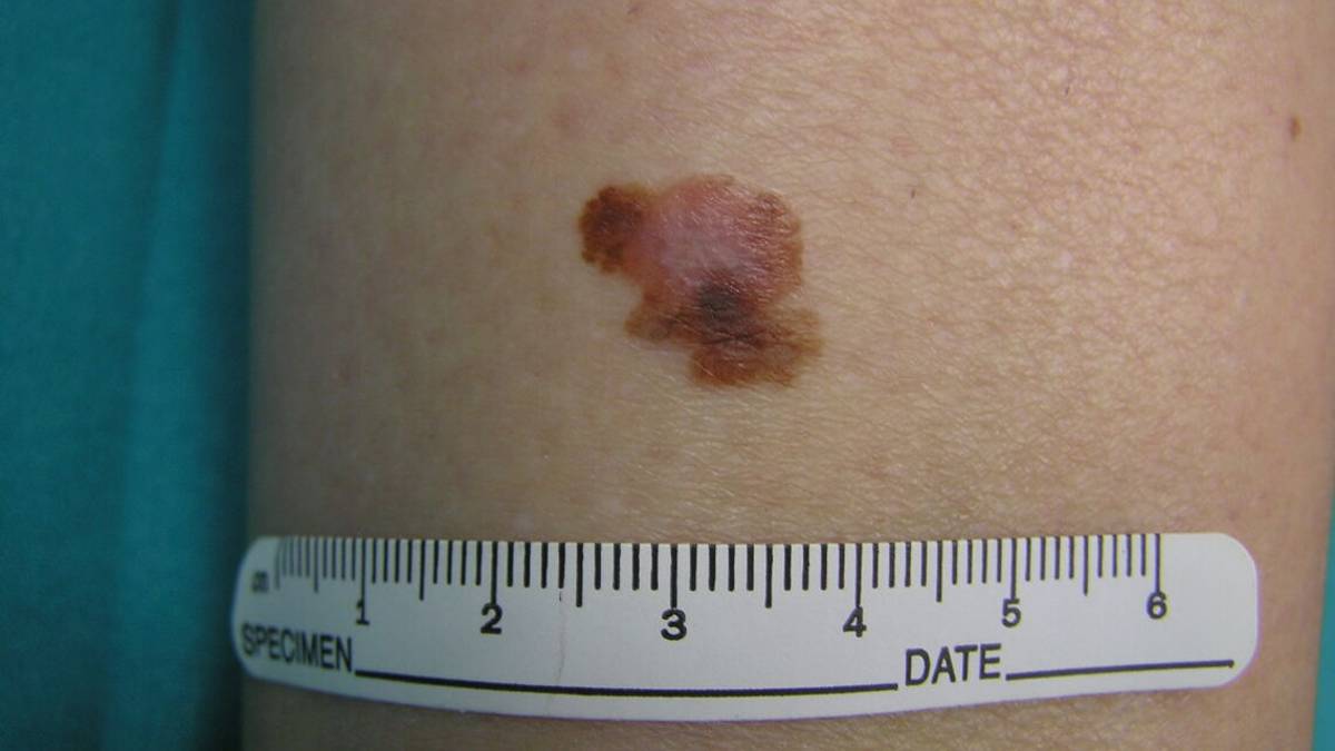 Visite anti melanoma gratis a Cesena per i 40 anni Arrt