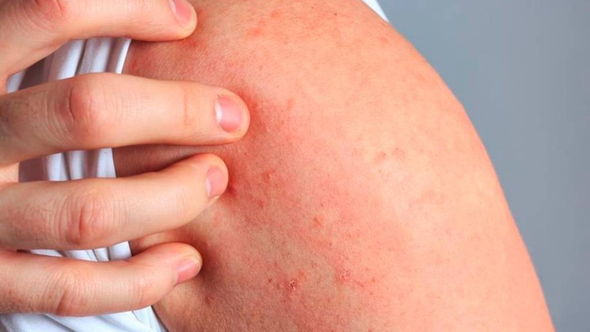 Cesena: un caso di scabbia circoscritto al liceo