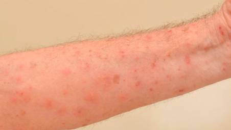 Segni della scabbia su un braccio