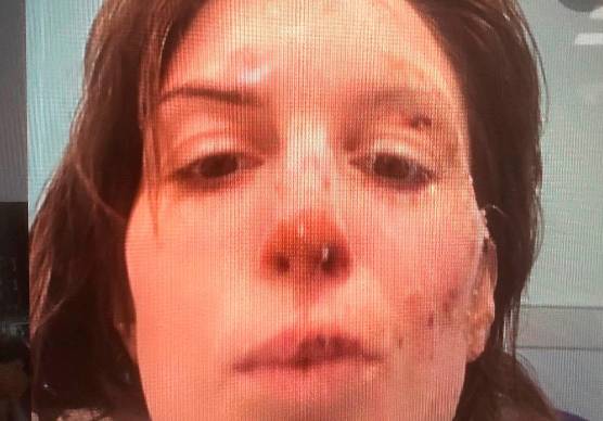 Rogo di Crans-Montana, la famiglia di Eleonora Palmieri: “Arrivata fattura da 17mila franchi svizzeri per 12 ore in ospedale a Sion, è vergognoso”