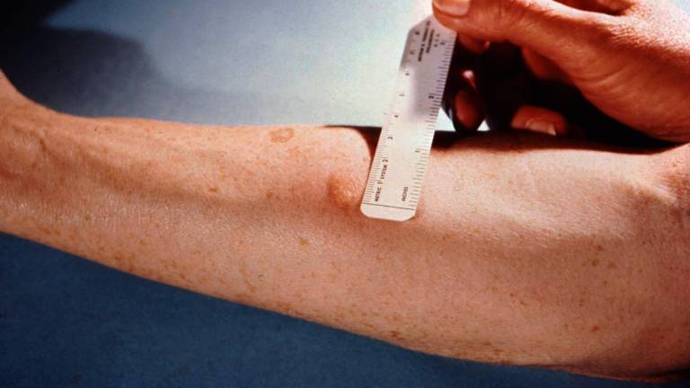 Santa Sofia. Bimba di 2 anni colpita da tubercolosi, ricoverata in gravi condizioni