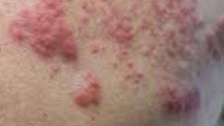 Herpes zoster, se lo incontriamo da bimbi resterà con noi