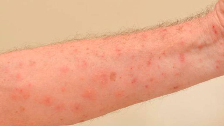 Segni della scabbia su un braccio