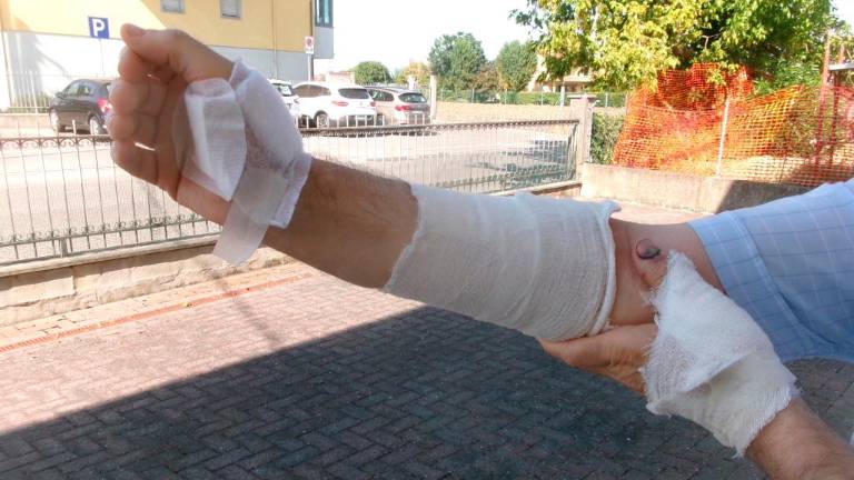 Il pensionato gambettolese mostra il braccio e le mani bendate per via delle ferite subite