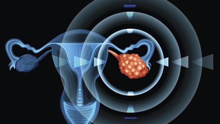 Giornata tumore ovarico: 5.000 donne colpite ogni anno. Le iniziative in Romagna