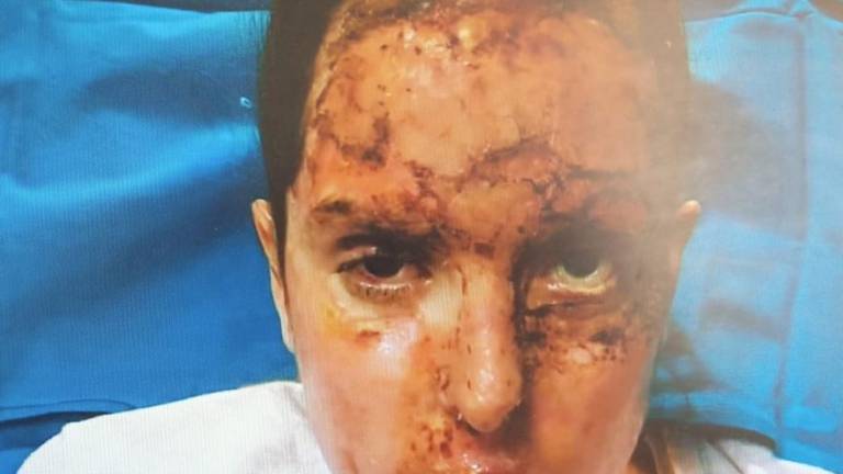 Gessica Notaro pubblica le foto dopo l'aggressione con l'acido